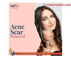 Massage and Spa Acne Scar Treatment in Hyderabad | Dermiq Clinic